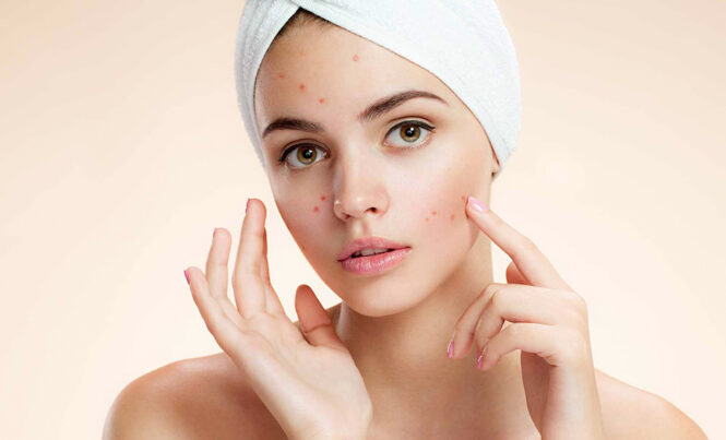 Don’t Be Sad Just Because Of Acne Problem – We Have A Solution!