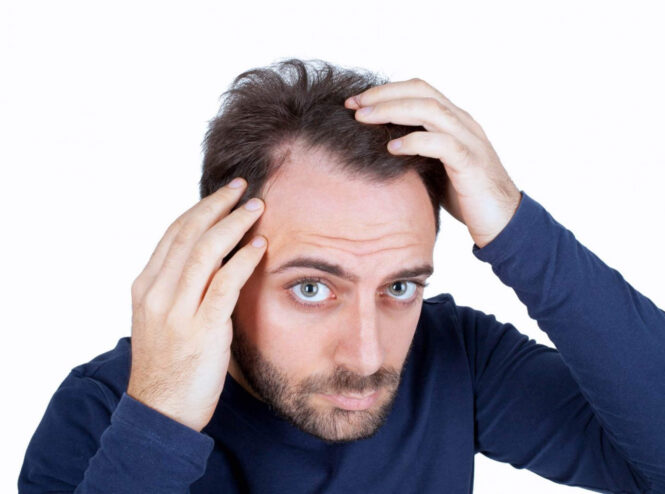 Balding Remedies – What You Can Do To Slow It Down Without A Doctor?