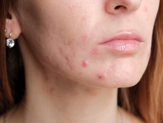 Causes of Pregnancy Acne & Home Remedies to Treat It