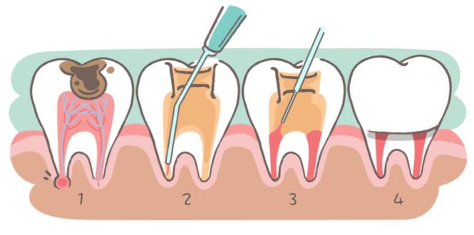4 Reasons That People Put Off Having a Root Canal - How to Prepare for It