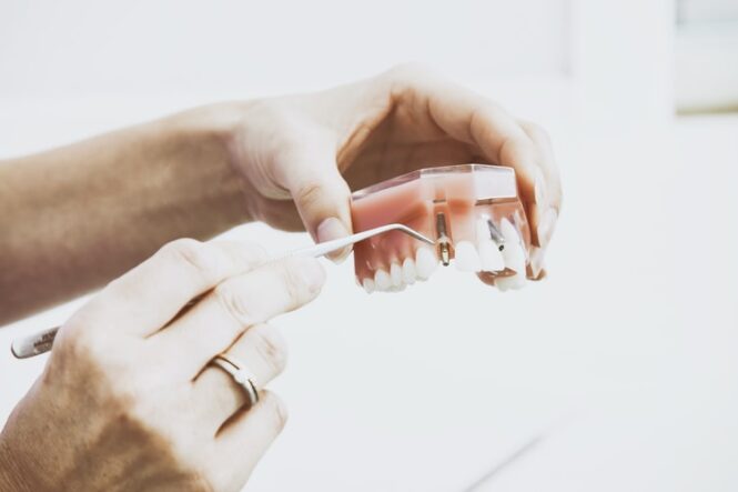 The Benefits of Dentures Vs. Dental implants