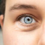 How Long Does It Take To Fully Recover after Lasik Eye Surgery