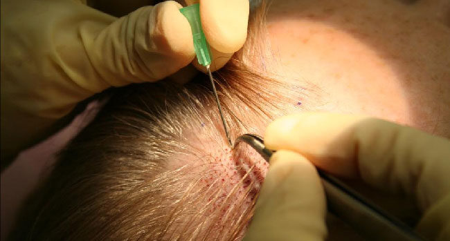 Natural Results - Follicular Unit Extraction
