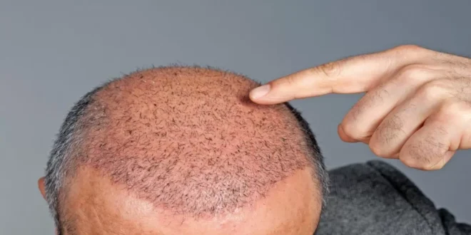The Rise of Medical Tourism - Why Hair Transplantation in Turkey is Making Waves