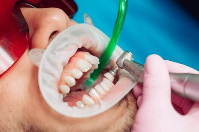Dental Work and Dental Surgery Prices In Turkey